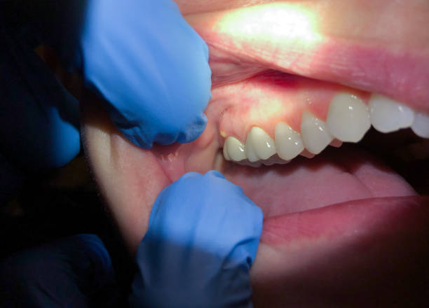 Best Emergency Wisdom Teeth Removal in Lookout Mountain, AL